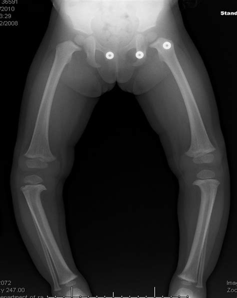 Blount’s Disease | Paley Orthopedic & Spine Institute