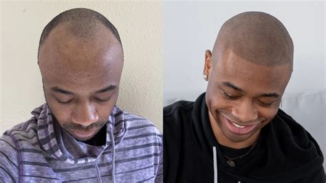 What Causes an Uneven Hairline and How can I Fix It? - Scalp Micro USA