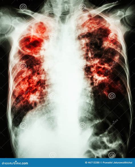 Tuberculosis Pulmonar Foto de archivo - Imagen: 46713288