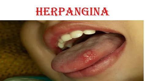 Herpangina - YouTube