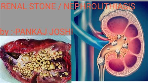 RENAL STONES /NEPHROLITHIASIS - YouTube