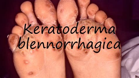 How to Pronounce Keratoderma blennorrhagica? - YouTube