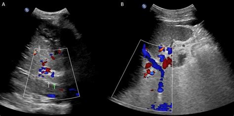 Splenic Vein Ultrasound