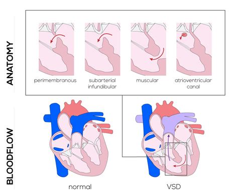 Pin by Melissa Blaker on Congenital Surgery | Congenital heart, Human ...