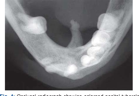 Genial Tubercle Radiograph