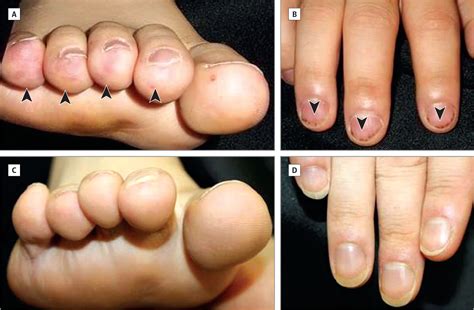 Janeway Lesions, Splinter Hemorrhages in Eosinophilic Endomyocarditis | Skin Imaging | JAMA ...