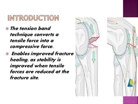 Principle of tension band wiring n its application