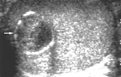 Testicular Cyst Ultrasound