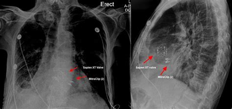 Heart Valve Replacement Xray