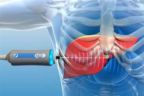 Fibroscan Liver Scan Device | Moonee Valley Specialist Centre