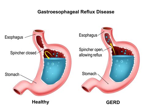 Gastroesophageal reflux disease by Tigatelu on Dribbble