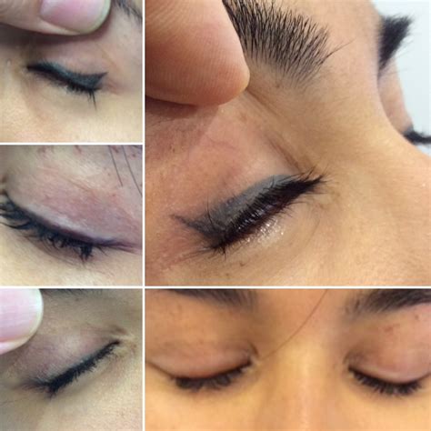 Eyeliner Tattoo Removal Process and Success