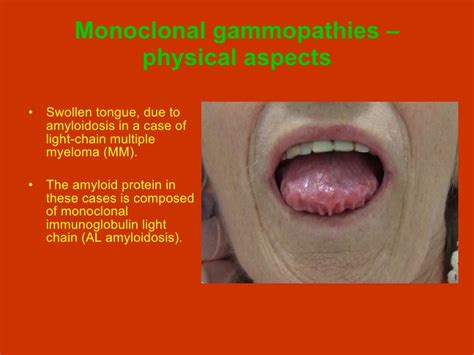 Monoclonal Gammopathies