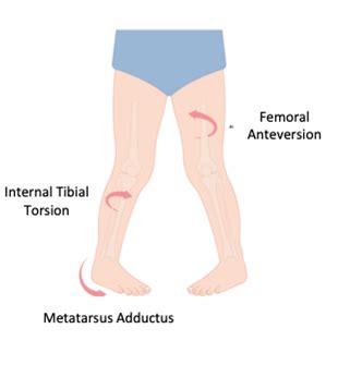 Variations in Gait: Intoeing | Renfrew Educational Services