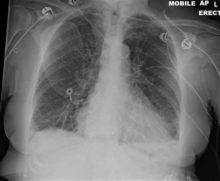 Kerley B Lines On Chest X Ray