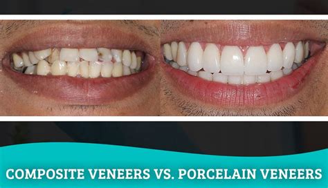 teeth veneers pros and cons