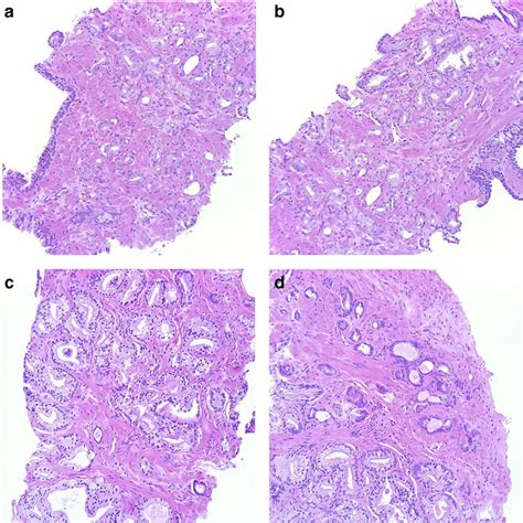 a, b Cancer bordering between Gleason score 3 + 3 = 6 with tangential ...