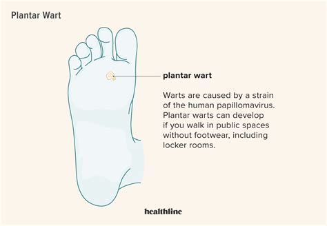 Plantar Wart: What is it, Symptoms, Treatment, and More