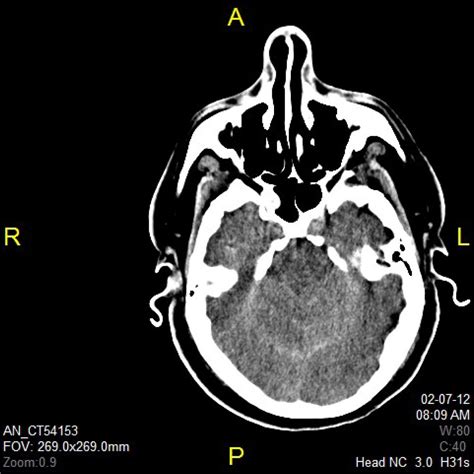 Remote Cerebellar Hemorrhage Complicating Unintended Durotomy in Lumbar Spine Surgery ...