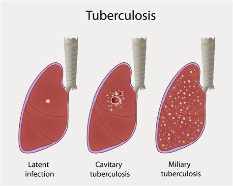 Tuberculosis - Health and Disease