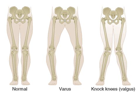 Osteoarthritis (Disorders of the Joints and Adjacent Tissues) (Rheumatology) Part 2