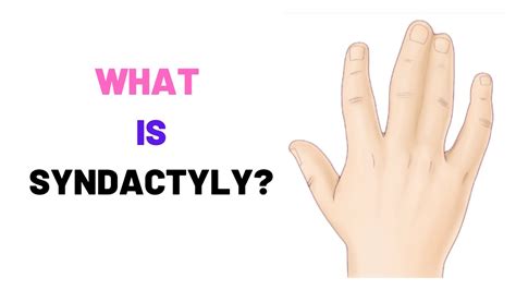 WHAT IS SYNDACTYLY? - WEBBED FINGERS, Causes, Symptoms, Treatment, Surgery - YouTube