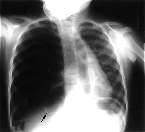 A strange case of a tension pneumothorax | Emergency Medicine Journal