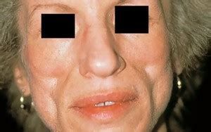 Lipodystrophy | Good Health