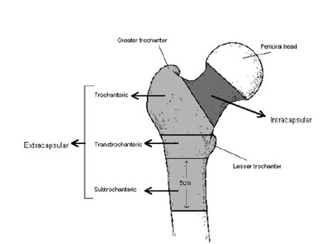 Fractured Neck of Femur - RCEMLearning