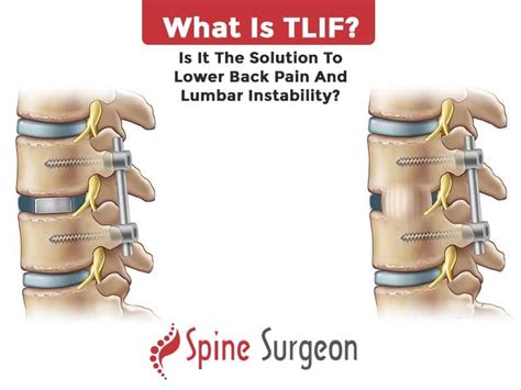 What is TLIF? Is it the solution to lower back pain and lumbar Instability? | Spine Surgeon