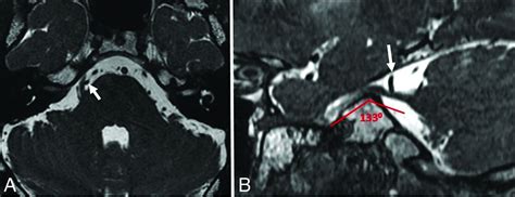 Trigeminal Nerve Mri Sagittal