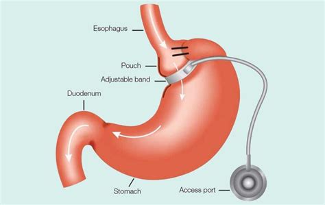 Gastric Banding Surgery – Health & Beauty Turkey