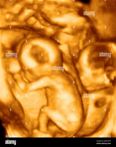 3D ultrasound scan of triplet foetuses at 15 weeks. Non-identical ...