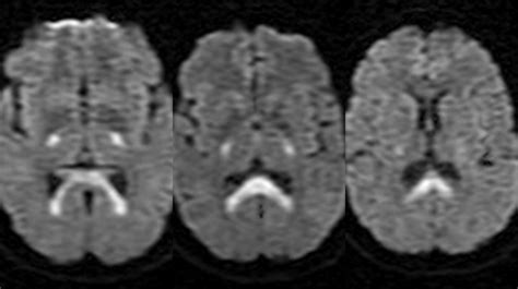 Dr Balaji Anvekar FRCR: Hypoglycemia induced restricted diffusion along bilateral posterior limb ...