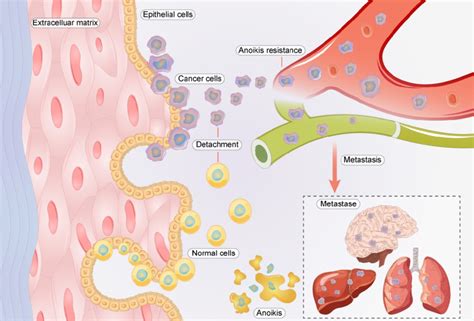 Relationship between anoikis resistance and metastasis of cancer cells. | Download Scientific ...