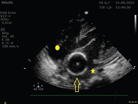 Echocardiography of the same patient with the balloon inflated (arrow ...