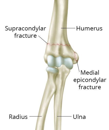 Elbow Fractures in Children - OrthoInfo - AAOS