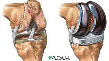 Bone Spurs In Knee: Causes, Symptoms & Treatment Of Knee Osteophytosis