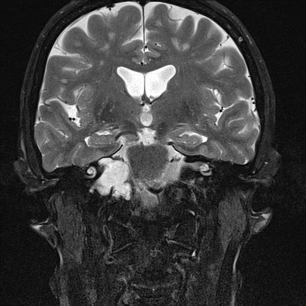 Base of skull chondrosarcoma | Radiology Case | Radiopaedia.org