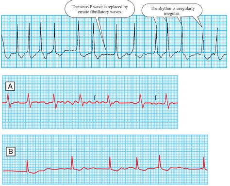 Atrial fibrillation - Rimikri Med