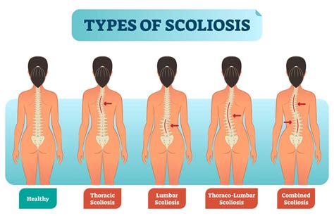 Scoliosis Treatment In KL | Chiropractic & Physiotherapy | Spinefit