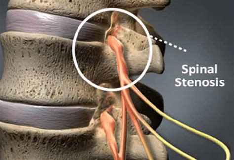 Neural Foraminal Stenosis | Causes, Symptoms & Treatment | Bonati