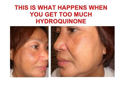 Hydroquinone - Alchetron, The Free Social Encyclopedia