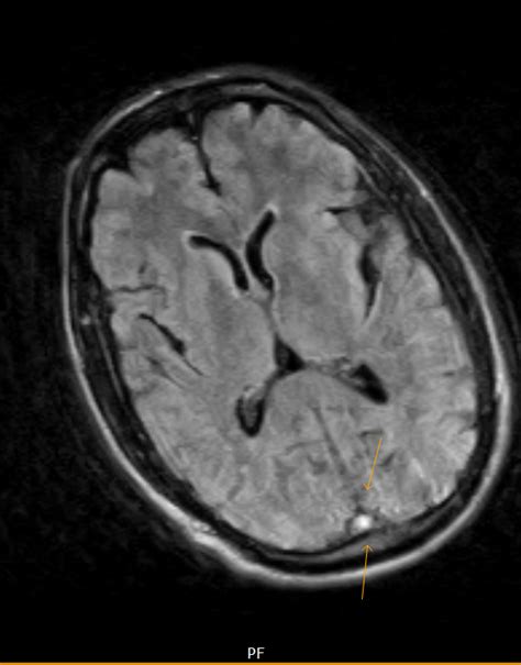 Superior Sagittal Thrombosis-MRI - Sumer's Radiology Blog