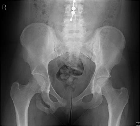 Ischial tuberosity avulsion fracture (chronic) | Image | Radiopaedia.org