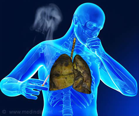 CAUSES AND PREVENTION OF TUBERCULOSIS - Health GadgetsNG