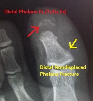 Distal Phalanx Fracture