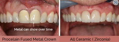 Why All-Ceramic crowns are better than Metal Ceramic Crown? – Karpagam Dental Care