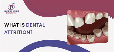 What is Dental Attrition? - Dental Clinic in Tirunelveli | Dentist in Tirunelveli