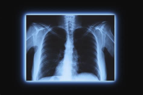 Xrays Definition Of Xrays By Medical Dictionary